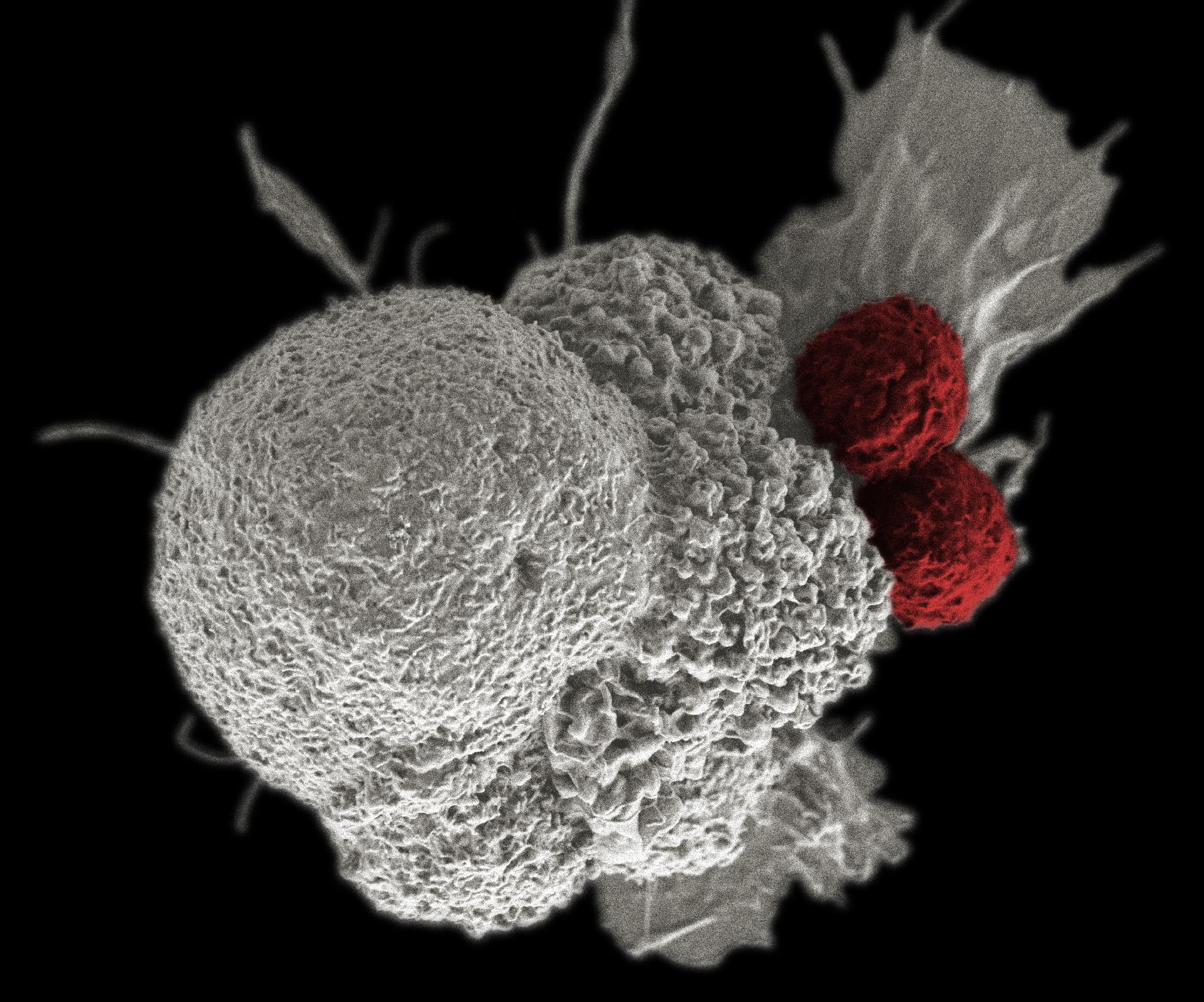agresszív rákos sejtek